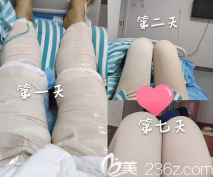 吸脂手術(shù)第1天和第二天還有第七天的樣子 吸脂手術(shù)第1天和第二天還有第七天的樣子