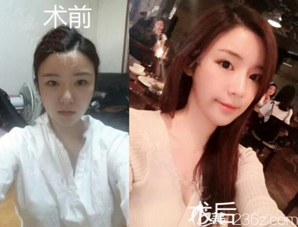 JJ洪鎮(zhèn)柱整形梁海元透明顴骨縮小術(shù)眼鼻部手術(shù) JJ洪鎮(zhèn)柱整形梁海元透明顴骨縮小術(shù)眼鼻部手術(shù)