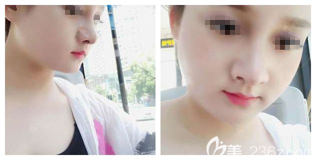 羨慕閨蜜的高鼻梁小V臉就對比常州前三名整形醫(yī)院后選定美貝爾做了鼻部綜合整形+瘦臉