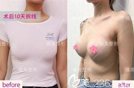 選擇在雅美做假體隆胸術(shù)后10天恢復(fù)效果 選擇在雅美做假體隆胸術(shù)后10天恢復(fù)效果