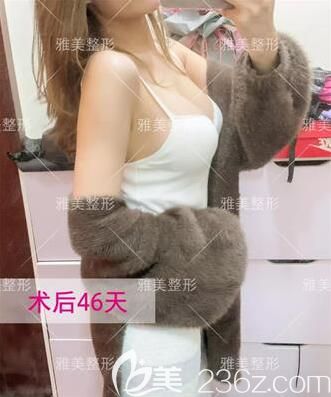 在雅美做假體隆胸術(shù)后46天恢復(fù)效果情況 在雅美做假體隆胸術(shù)后46天恢復(fù)效果情況