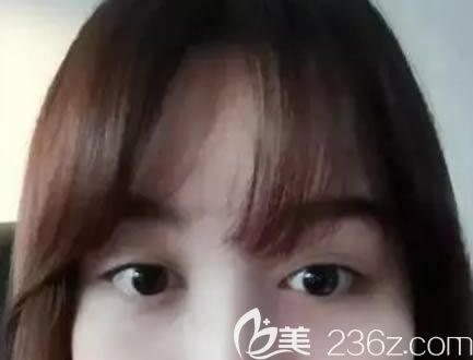 術(shù)前做失敗的雙眼皮照片 術(shù)前做失敗的雙眼皮照片