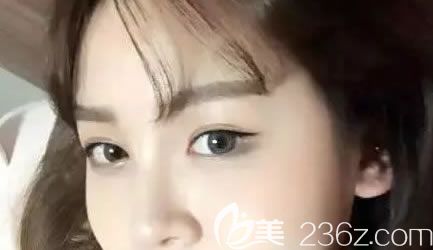 二次做雙眼皮經(jīng)歷,義烏陽光整形美容醫(yī)院結(jié)束了我做雙眼皮失敗的噩夢