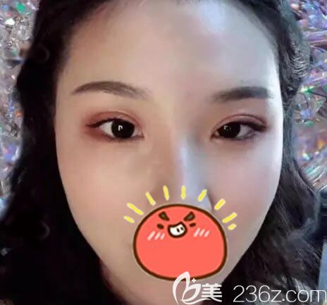 趁著浙江義烏陽光整形5月優(yōu)惠活動做了全切雙眼皮跟開眼角手術(shù)