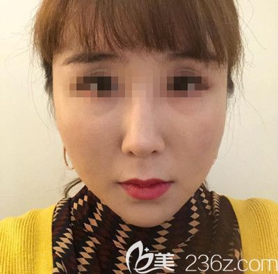 在韓國寶士麗做埋線手術(shù)前 在韓國寶士麗做埋線手術(shù)前