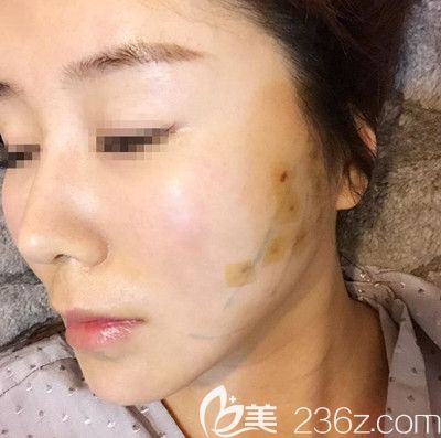 在韓國寶士麗做埋線手術(shù)第1天 在韓國寶士麗做埋線手術(shù)第1天