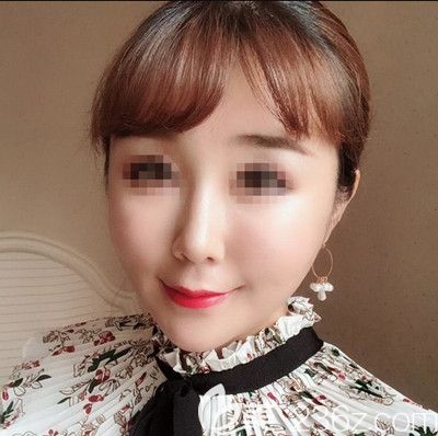 在韓國寶士麗做埋線手術(shù)后5天 在韓國寶士麗做埋線手術(shù)后5天