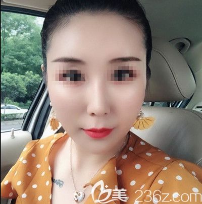 在韓國寶士麗做埋線手術(shù)后1個月 在韓國寶士麗做埋線手術(shù)后1個月