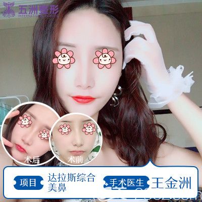 五洲萊美王金洲醫(yī)生做達(dá)拉斯鼻綜合術(shù)后效果 五洲萊美王金洲醫(yī)生做達(dá)拉斯鼻綜合術(shù)后效果