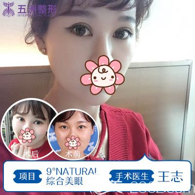 王志做綜合美眼術(shù)術(shù)前術(shù)后對比圖 王志做綜合美眼術(shù)術(shù)前術(shù)后對比圖