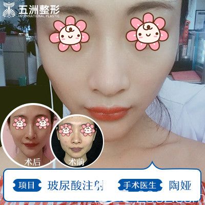 陶婭醫(yī)生面部注射玻尿酸改善面部凹陷效果 陶婭醫(yī)生面部注射玻尿酸改善面部凹陷效果