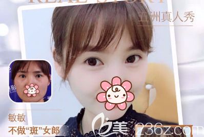 超皮秒祛斑術(shù)前術(shù)后對比 超皮秒祛斑術(shù)前術(shù)后對比