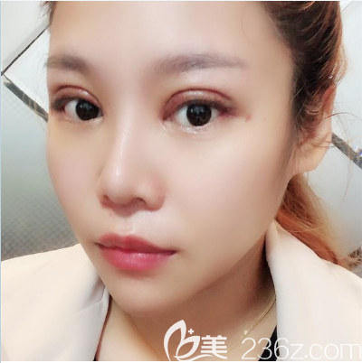 深圳米蘭柏羽朱武根雙眼皮修復(fù)案例術(shù)后7天 深圳米蘭柏羽朱武根雙眼皮修復(fù)案例術(shù)后7天