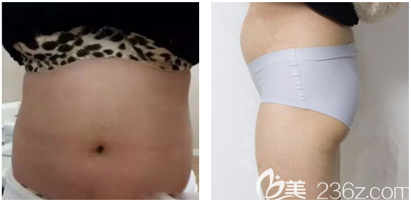 在深圳瑞澤瑞尼絲做腰腹環(huán)吸術(shù)前照片 在深圳瑞澤瑞尼絲做腰腹環(huán)吸術(shù)前照片