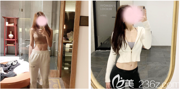 深圳瑞澤瑞尼絲腰腹環(huán)吸兩個(gè)月親身經(jīng)歷 深圳瑞澤瑞尼絲腰腹環(huán)吸兩個(gè)月親身經(jīng)歷