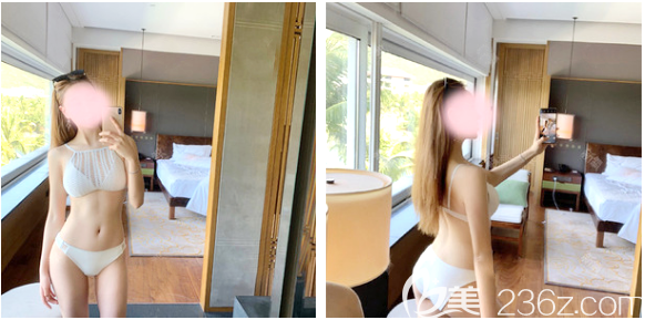 公開我去深圳潤澤瑞尼絲找陳敬武做腰腹環(huán)吸的親身經(jīng)歷和吸脂術(shù)后恢復過程圖