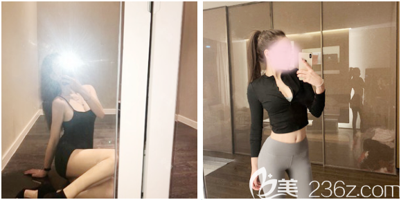 腰腹環(huán)吸術(shù)后恢復(fù)過(guò)程圖片 腰腹環(huán)吸術(shù)后恢復(fù)過(guò)程圖片