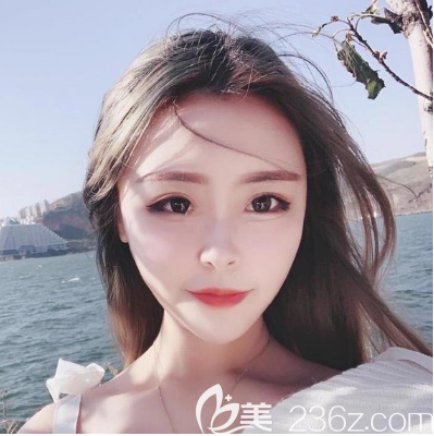 鼻綜合隆鼻和自體脂肪填充全臉術后30天 鼻綜合隆鼻和自體脂肪填充全臉術后30天