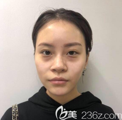 在<!--<i data=20240703-sp></i>-->做隆鼻和脂肪填充術前照片 在<!--<i data=20240703-sp></i>-->做隆鼻和脂肪填充術前照片