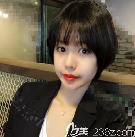 那木整形醫(yī)院隆鼻真人案例 那木整形醫(yī)院隆鼻真人案例