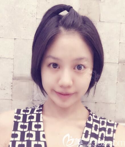 韓國那木整形顴骨VLINE下頜角鼻綜合prp脂肪移植不得不承認(rèn)變化很大