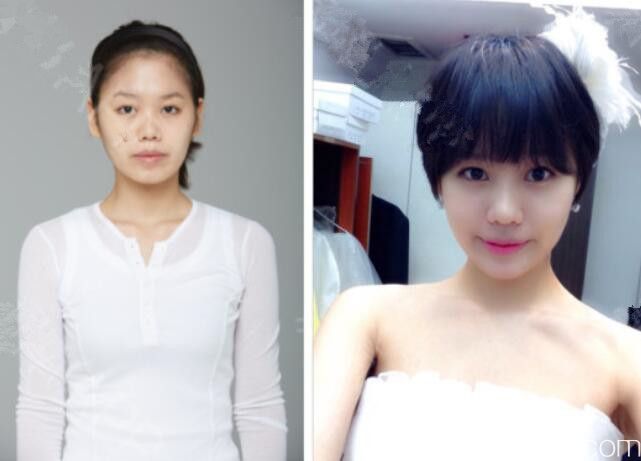 那木整形醫(yī)院輪廓真人案例 那木整形醫(yī)院輪廓真人案例