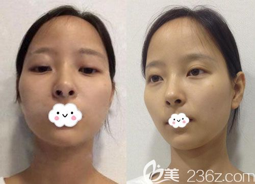 韓國麥恩李圣郁隆胸后又來做面部輪廓+額頭縮小術(shù)+雙眼皮真人案例 韓國麥恩李圣郁隆胸后又來做面部輪廓+額頭縮小術(shù)+雙眼皮真人案例