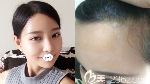 韓國麥恩額頭縮小術(shù)后1個月恢復(fù)圖與疤痕情況 韓國麥恩額頭縮小術(shù)后1個月恢復(fù)圖與疤痕情況