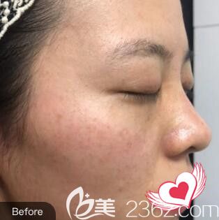 在雅美祛斑術(shù)前照 在雅美祛斑術(shù)前照