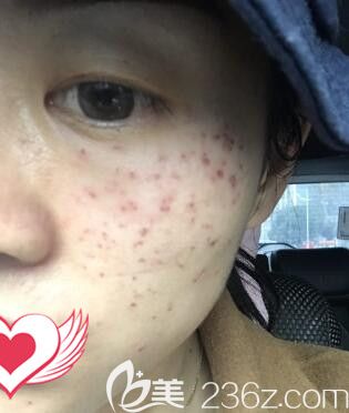 在雅美做皮秒祛斑術(shù)后照 在雅美做皮秒祛斑術(shù)后照