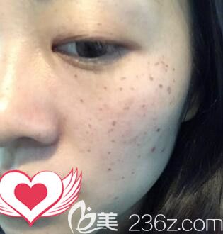 在雅美做皮秒祛斑術(shù)后5天效果 在雅美做皮秒祛斑術(shù)后5天效果