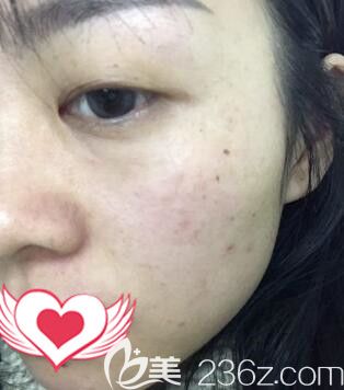 在長(zhǎng)沙雅美做皮秒祛斑術(shù)后16天效果 在長(zhǎng)沙雅美做皮秒祛斑術(shù)后16天效果