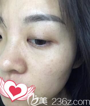 在長(zhǎng)沙做皮秒祛斑術(shù)后26天恢復(fù)效果 在長(zhǎng)沙做皮秒祛斑術(shù)后26天恢復(fù)效果