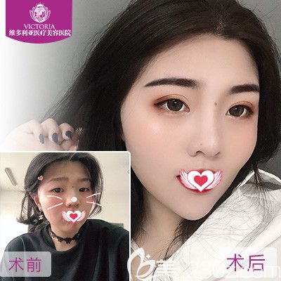 張家口維多利亞做雙眼皮案例 張家口維多利亞做雙眼皮案例