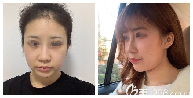 面診南通維多利亞術(shù)前大腮幫子 面診南通維多利亞術(shù)前大腮幫子