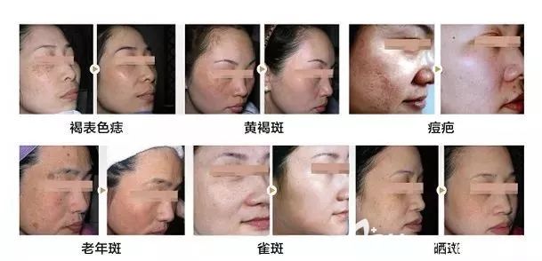 蘇州康美皮秒祛斑案例