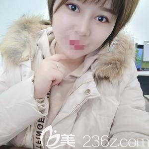 鄭州菲林駱豫醫(yī)生做玻尿酸填充下巴術(shù)后6天