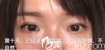 濟(jì)南做去眼袋手術(shù)好的醫(yī)院是濟(jì)南美蓮，分享我在美蓮做的去眼袋以及脂肪填充日記