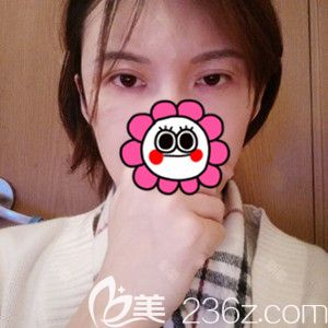 在韓國芭堂做雙眼皮修復手術前 在韓國芭堂做雙眼皮修復手術前