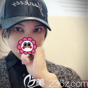 在韓國芭堂做雙眼皮修復手術后5天 在韓國芭堂做雙眼皮修復手術后5天