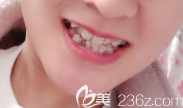 沈陽(yáng)百嘉麗口腔陶瓷托槽正畸術(shù)中照