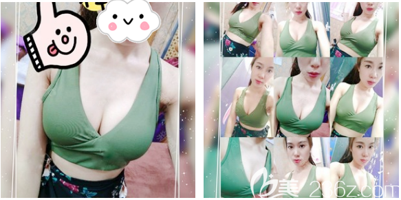 假體隆胸術(shù)后22天恢復(fù)效果圖 假體隆胸術(shù)后22天恢復(fù)效果圖