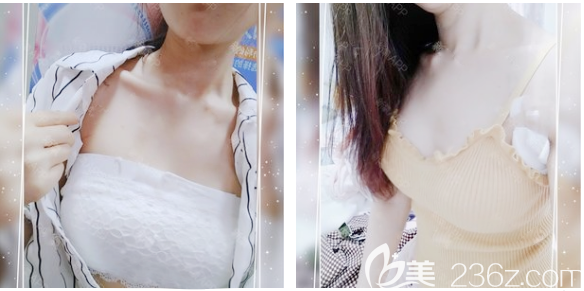 東莞壹加壹假體隆胸7天拆線 東莞壹加壹假體隆胸7天拆線