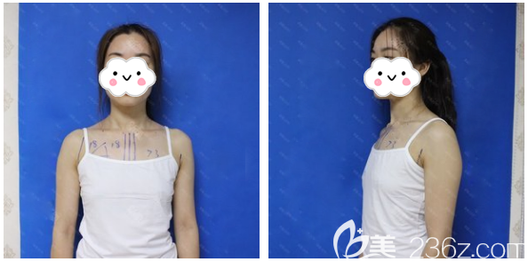 在東莞壹加壹做隆胸術(shù)前照片 在東莞壹加壹做隆胸術(shù)前照片