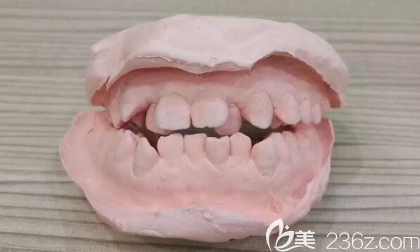 深覆頜矯正前取牙模的樣子 深覆頜矯正前取牙模的樣子