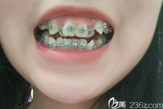 在聊城口腔醫(yī)院矯正深覆合24天 在聊城口腔醫(yī)院矯正深覆合24天