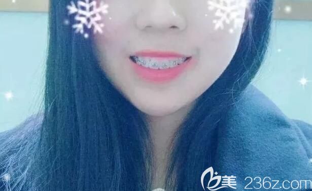 牙齒矯正快4個(gè)月 牙齒矯正快4個(gè)月