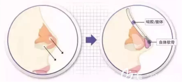 隆鼻手術(shù)假體與自體軟骨放置位置示意圖 隆鼻手術(shù)假體與自體軟骨放置位置示意圖