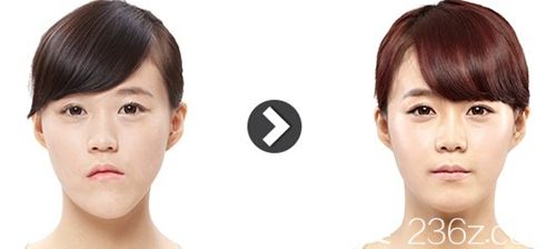 韓國ID雙鄂手術(shù)案例