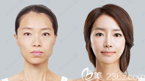 韓國ID醫(yī)院輪廓三件套手術(shù)案例